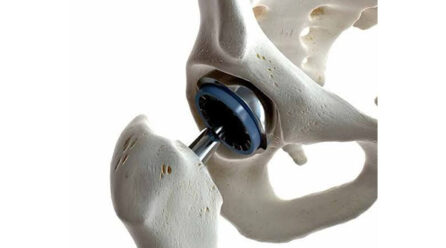 Hip Replacement Recovery: Q&A with a Hip Specialist